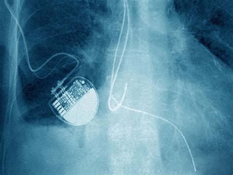  Dextran: Quelle Influence Incroyable sur les Implants Médicaux !